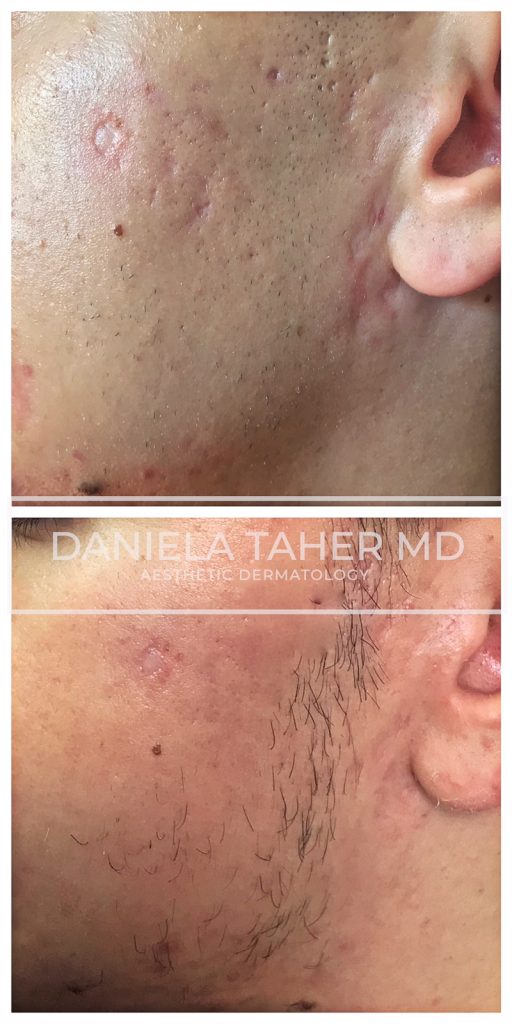 cicatrici acnee dr Daniela Taher Skin Clinic Bucuresti